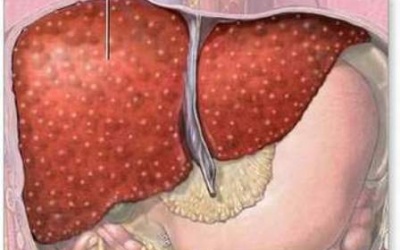 Viêm gan B: Vì sao phải điều trị sớm?