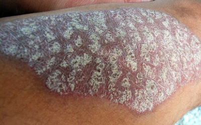 Vảy cá: Cần điều trị ngay