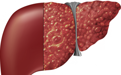 Xơ gan - Hiểm họa khôn lường!