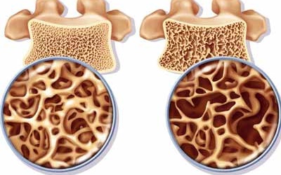 Chống loãng xương không phải chỉ cần Calci