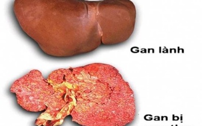 Ung thư gan có chữa được không?