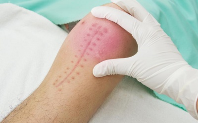 Đừng đùa với… sẹo