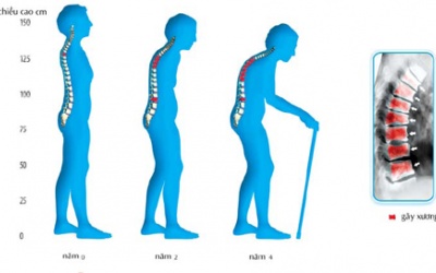 Loãng xương: 13% chẩn đoán nhầm!