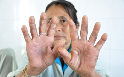 Quảng Ngãi: Viêm da dày sừng tái phát