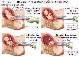 Thai phụ 8 tháng  vẫn nạo hút được?