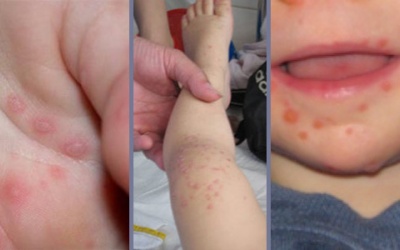 Làm gì để tránh bệnh tay chân miệng?