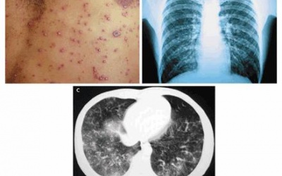 Mắc thủy đậu: Không thể chủ quan