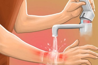 Có nên rắc bột kháng sinh lên vết bỏng?