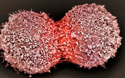 Phát hiện loại gene mới gây ung thư vú