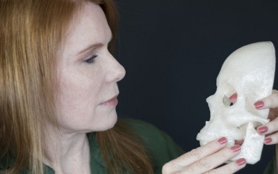 Loại bỏ thành công u não nhờ... máy in 3D