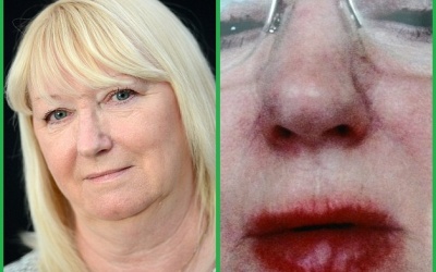 Môi sưng phù do dị ứng son bóng Dior