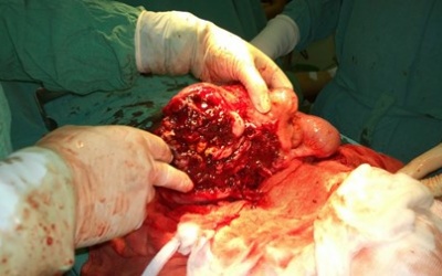 Phẫu thuật thành công cho bệnh nhân có khối u mạc treo phức tạp