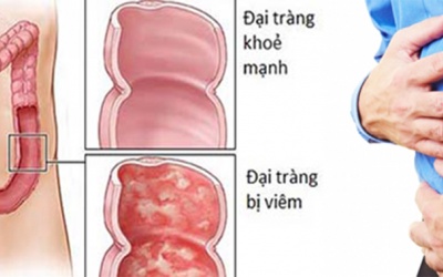 Viêm đại tràng: Điều trị muộn là thiệt