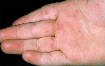 Bệnh tay chân miệng diễn biến bất thường ngay từ đầu năm