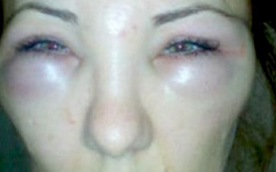 Mặt tê liệt vì tiêm boxtox Trung Quốc