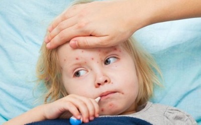 Dịch sởi quay lại tấn công nước Mỹ