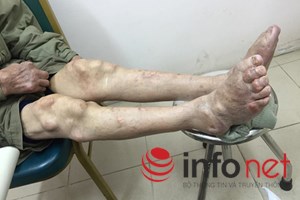 Suy thận vì điều trị gout ở phòng khám Đông y Trung Quốc