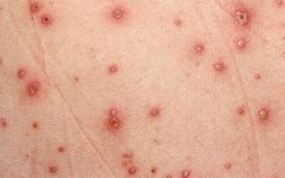 Dinh dưỡng ngăn ngừa sởi, thủy đậu