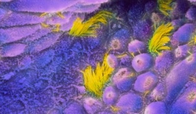 Nguy cơ ung thư từ liệu pháp thay thế hormone