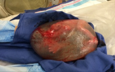 Kỳ lạ em bé chào đời hai lần