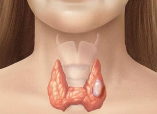 Những bệnh tuyến giáp thường gặp