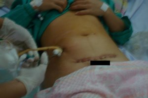 Những sản phụ có nguy cơ vỡ tử cung