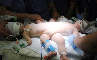 Tách thành công cặp song sinh dính liền thân dưới