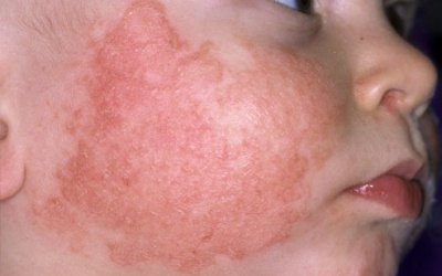 Tại sao trẻ bị chàm?