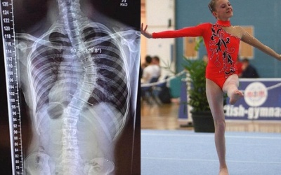 Cột sống cong 45 độ vì... đột nhiên cao