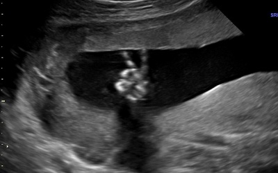 Em bé giơ ngón tay chữ V trong bụng mẹ