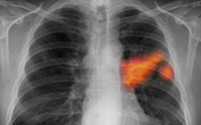 Liệu pháp tế bào gốc trong điều trị ung thư phổi được thử nghiệm tại Anh