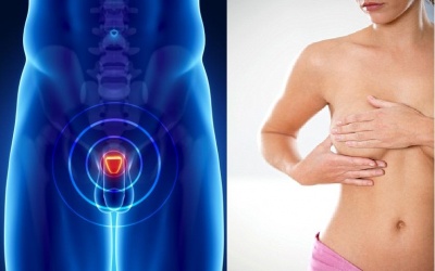 Ung thư vú có 'họ hàng' với ung thư tuyến tiền liệt
