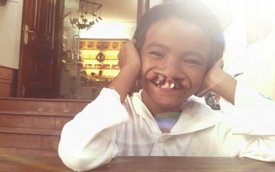 Xúc động hành trình tìm lại nụ cười của em bé bị gọi là quỷ