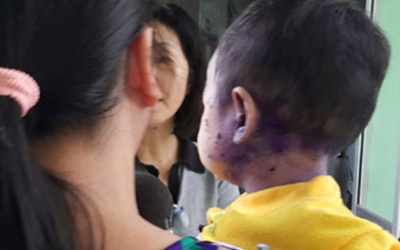 Gia tăng bệnh nhân thủy đậu thể nặng