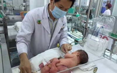 Bóc thành công u quái khổng lồ cho bé gái sơ sinh