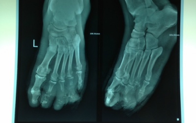 Tháo khớp nửa bàn chân vì nhiễm trùng do đái tháo đường đường