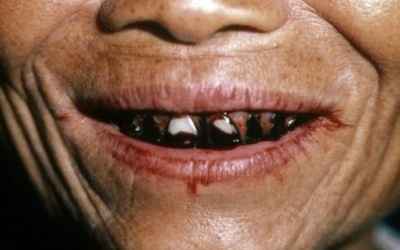 Hàng chục ngàn cái chết mỗi năm vì... trầu cau!