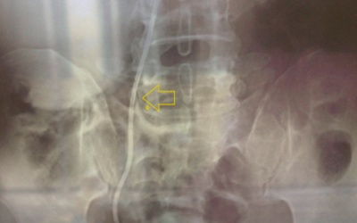 Ông cụ bỏ quên ống thông trong người 4 năm