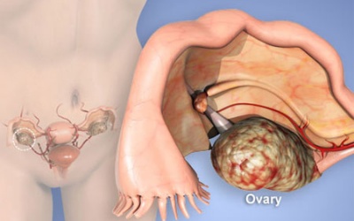 Nên hay không cắt buồng trứng dự phòng ung thư?