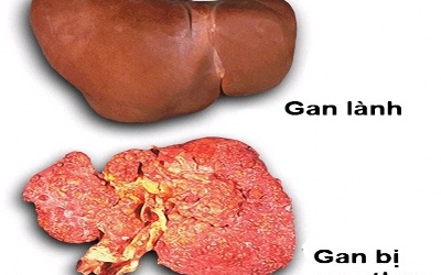 Ung thư gan - Dễ chết, khó phát hiện