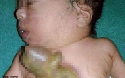 Bé gái sơ sinh có trái tim... nằm ngoài lồng ngực