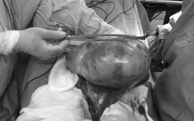 Bé gái 13 tuổi có khối u buồng trứng 3,5kg