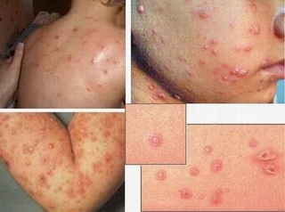 Cảnh báo bệnh thủy đậu đang vào mùa