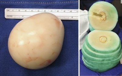 Khối u to như quả trứng ngỗng trong bàng quang