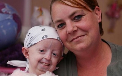 ​Cô bé mắc chứng lão hóa sớm qua đời ở tuổi 17