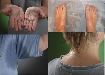 Ra mồ hôi nhiều thì phải làm sao?