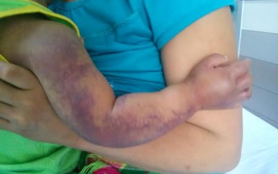 Bé 2 tuổi có nguy cơ mất cánh tay do rắn độc cắn