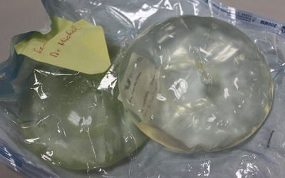 Ngực tách làm đôi vì nâng cấp bằng túi ngực giả