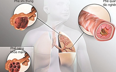 Bệnh phổi tắc nghẽn mạn tính điều trị bằng thuốc gì?