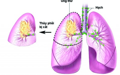 Những dấu hiệu cảnh báo ung thư